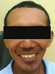 Redalyc.Fibroma ameloblástico. Reporte de un caso clínico