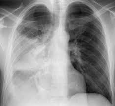 Primary Tuberculosis Imaging Overview Radiography Computed Tomography Radiography Tuberculosis Pet Ct