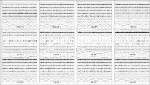 El cambio conceptual que significó la me, es un importante punto de inflexión en la trasplantología. Registro Del Eeg Y De Sus Primeros Seis Componentes De Descomposicion Download Scientific Diagram