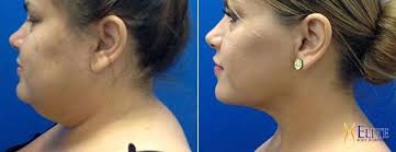 Woman Inspired by Her Chin Fat Removal Surgery Gets Healthy and Loses 70  Lbs.