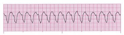 Free acls test answers to pass acls quiz. Acls Pretest Questions And Answers 2020 Full Practice Test