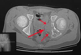 Image result for Ewing Sarcoma