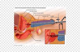 Transurethrale Resektion Der Prostata Prostatakrebs Gutartige Prostatahyperplasie Operation Transurethrale Resektion Der Prostata Winkel Benigne Prostatahyperplasie Krebs Png Pngwing