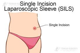 Gastric sleeve surgeries should be available for everybody. Sleeve Surgery Scars Scaring After Gastric Sleeve Surgery