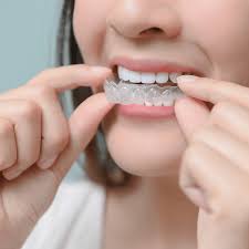 These estimates are for a single appliance, lower or upper. Retainers Silver Spring Straighten Up Orthodontics Straighten Up Orthodontics