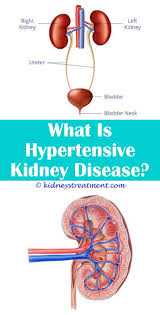 Kidney Cleanse How To Make Kidney Disease Symptoms Kidney Disease Chronic Kidney Disease