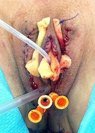 Maybe you would like to learn more about one of these? Combined Vaginoplasty Technique For Male To Female Sex Reassignment Surgery Operative Approach And Outcomes Journal Of Plastic Reconstructive Aesthetic Surgery