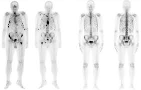 You might have a bone scan to find out if prostate cancer has spread to the bone. Plos One Bone Metastasis Classification Using Whole Body Images From Prostate Cancer Patients Based On Convolutional Neural Networks Application