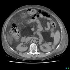 Comparison of quantitative fat assay and a novel assay using fecal. Complete Pancreatic Lipomatosis Cystic Fibrosis Radiology Case Radiopaedia Org