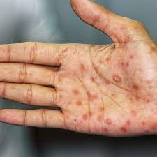 Sores in your mouth, vagina, or anus. Kila Syfilis Diagnostyka I Leczenie Ot Co Clinic