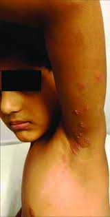 Herpes zoster in a 2-year-old child with grouped vesicles and... | Download  Scientific Diagram