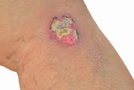 That can hurt and cause irritation. Wound Infection The Basics You Should Know Advanced Tissue