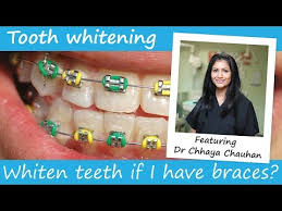 So, let's talk about traditional braces that are attached to the teeth. Can You Whiten Your Teeth With Braces On Electric Teeth