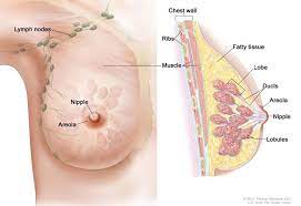 Once breast cancer has spread beyond the breast it is considered stage 4 and is no longer considered curable.it can definitely be treated and i know women who have mets who are still alive many years later.they do need treatment but there are many different ways to treat it. Breast Cancer Huntsman Cancer Institute