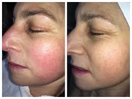 Microneedling