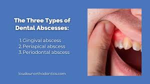 Image result for Periodontal Abscess