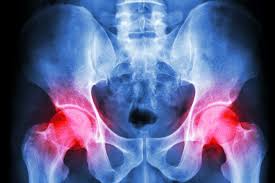 Cordin huszar si tuturor infirmierelor si asistentelor. Proteza TotalÄƒ De Sold Sk S