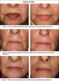 Pin On Red Light Therapy For Facial Aging Wrinkles Fine Lines