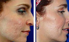 Intense pulsed light (ipl), which involves a series of short pulses of light. Acne Scars Laser Removal Treatment Richmond Va Travis Shaw Md