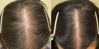 Should you move towards the topical solution? Finasteride Females Before After Photos Hair Restoration Of The South New Orleans La