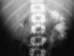 Image result for Genitourinary Tuberculosis