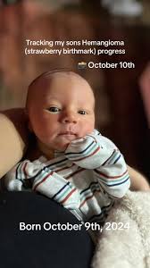 Hemangioma Babies Dla