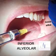 Image result for Periapical Block