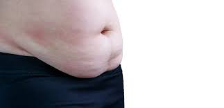 In some instances, however, a patient may have a hernia and not just a spreading of the abdominal muscles. Panniculectomy Surgery Post Bariatric Body Contouring
