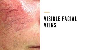 Why Are The Veins On My Face So Visible Vein Solutions