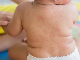 Quando compare l'orticaria, gli alimenti sono i principali indiziati: L Orticaria E Stimolata Anche Dal Sudore E Dal Caldo Guida Genitori