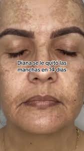 Adiós pańos 🤣👋 #melasma #manchas #tonicodespigmentante #cuidadodepie...