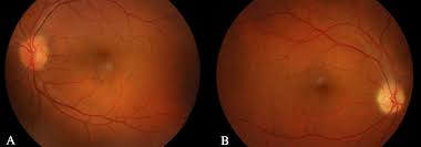 Cureus A Rare Cause Of Optic Neuropathy