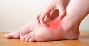 Picor En Los Pies Por Que Me Pican Como Puedo Evitarlo Podoactiva Lideres En Podologia