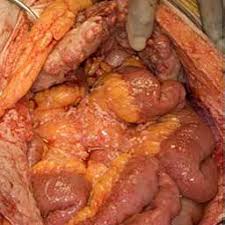 It is the most common cell type and is most responsive to treatment. Epithelioid Peritoneal Mesothelioma Download Scientific Diagram