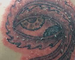 Image result for koebner phenomenon psoriasis