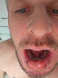 Injuries while working