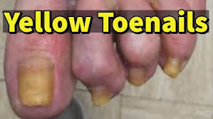 Image result for Yellow nail syndrome feet