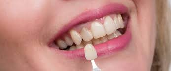 تعرف على أضرار تلبيس الأسنان ويب طب