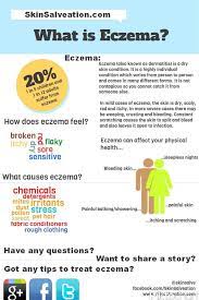 Eczema Treatment Eczema Remedies How To Treat Eczema