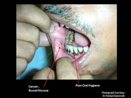 Sometime the tumor can be quite large, affecting the person's ability to speak or swallow. Symptoms Early Signs Of Oral Cancer Arecapedia