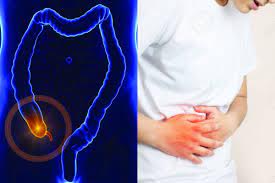 Seorang pembaca kompas.com yang bernama fitri telah beberapa kali mengalami sakit perut di sebelah kanan. Ini 7 Gejala Usus Buntu Bukan Cuma Sakit Perut Sebelah Kanan Semua Halaman Intisari