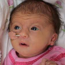 It is caused by an extra copy of chromosome 18 and babies born with the condition usually do not survive for much. Edwards Syndrome Edwardssyndrome Twitter