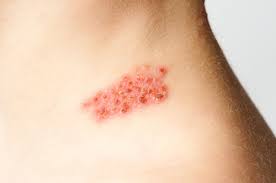 Image result for shingles in children