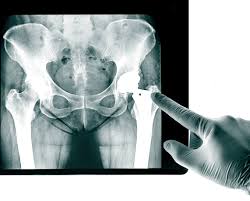 Image result for Hip XRay