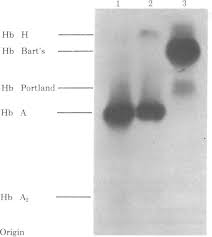 Starch Gel Electrophoresis Of Hemolysates From Lane 1 A Normal Adult Download Scientific Diagram