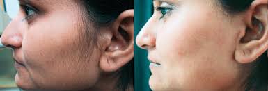 Use sun block spf 30 or greater on treated areas and avoid direct sun exposure for 7 days after laser treatments. Laser Hair Removal Photos Chevy Chase Md Patient 13767