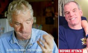 Man who had his face torn off by a bear describes how he managed to survive  the horror attack