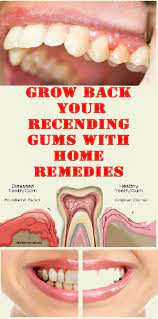 Easy Ways To Heal Receding Gums Naturally Gum Recession Receding Gums Gum Health