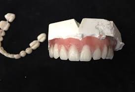 Diy Kit Denture Resin Teeth Upper Lower Best Denture Kit Etsy Affordable Dentures Denture Denture Adhesive