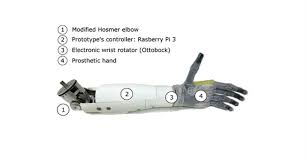 However, shortly thereafter, the company announced in july. Prosthetic Arm Decodes Phantom Limb Movements Covering The Specialized Field Of Orthopedic Product Development And Manufacturing